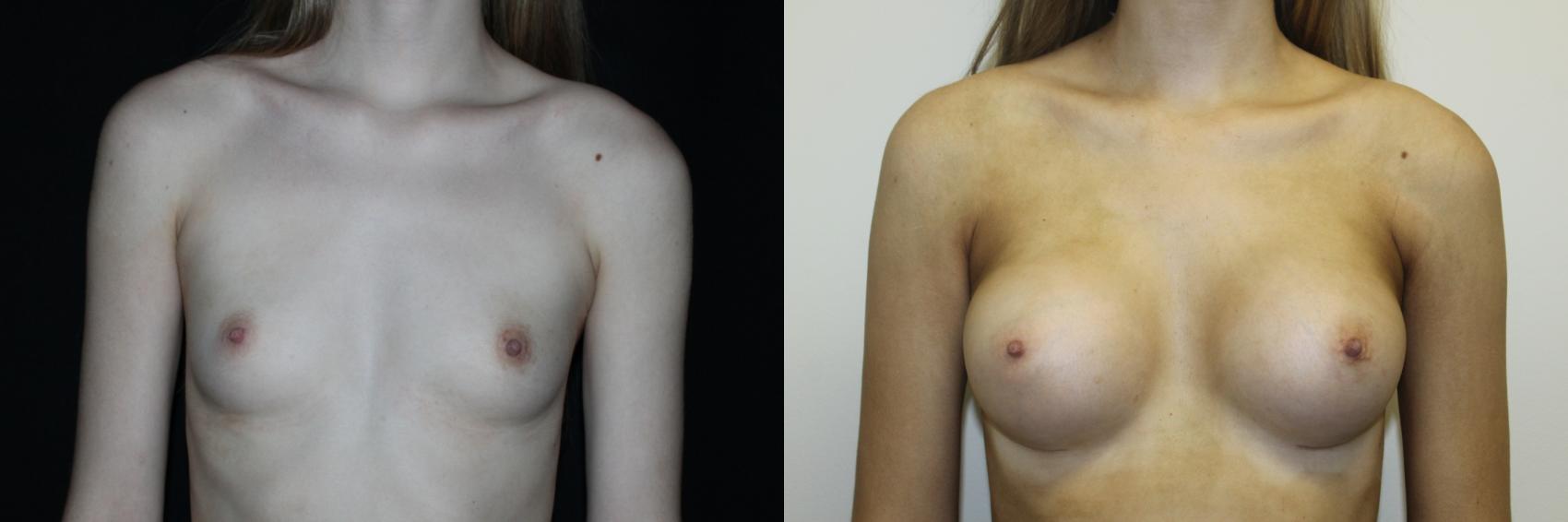 Before & After Breast Augmentation Case 81 Front View in Charleston, SC