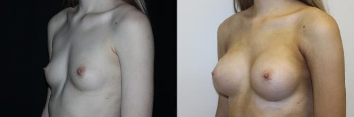 Before & After Breast Augmentation Case 81 Left Oblique View in Charleston, SC