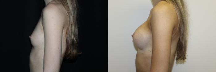 Before & After Breast Augmentation Case 81 Left Side View in Charleston, SC
