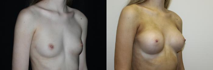 Before & After Breast Augmentation Case 81 Right Oblique View in Charleston, SC