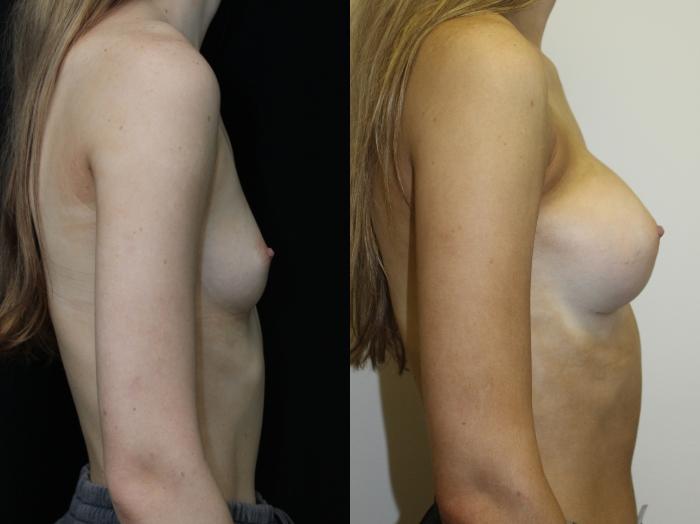 Before & After Breast Augmentation Case 81 Right Side View in Charleston, SC