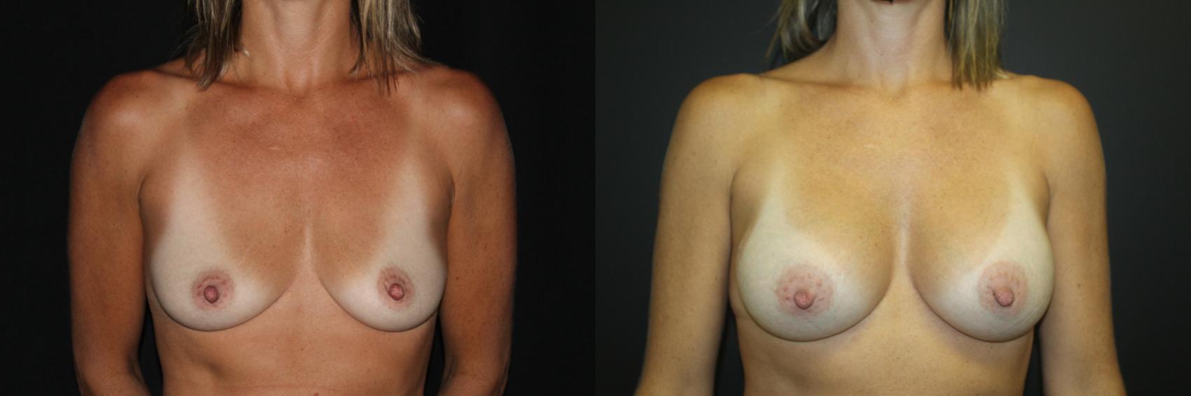 Before & After Breast Augmentation Case 82 Front View in Charleston, SC