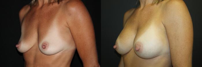 Before & After Breast Augmentation Case 82 Left Oblique View in Charleston, SC