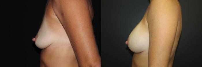 Before & After Breast Augmentation Case 82 Left Side View in Charleston, SC