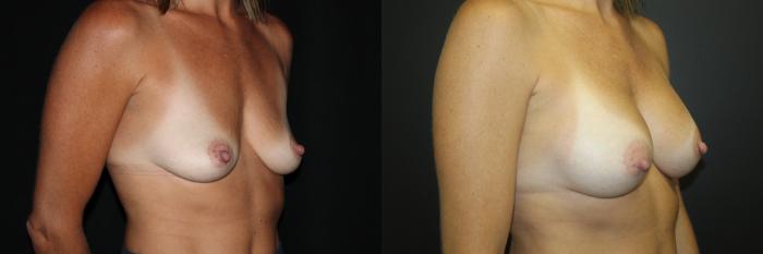 Before & After Breast Augmentation Case 82 Right Oblique View in Charleston, SC