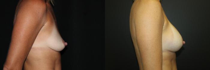 Before & After Breast Augmentation Case 82 Right Side View in Charleston, SC
