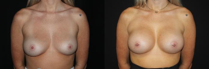 Before & After Breast Augmentation Case 83 Front View in Charleston, SC