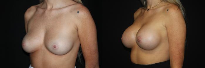 Before & After Breast Augmentation Case 83 Left Oblique View in Charleston, SC