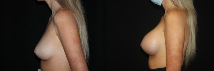 Before & After Breast Augmentation Case 83 Left Side View in Charleston, SC