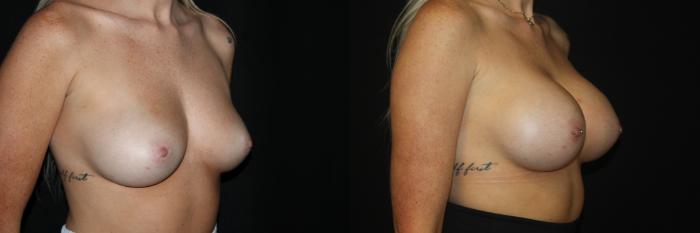 Before & After Breast Augmentation Case 83 Right Oblique View in Charleston, SC