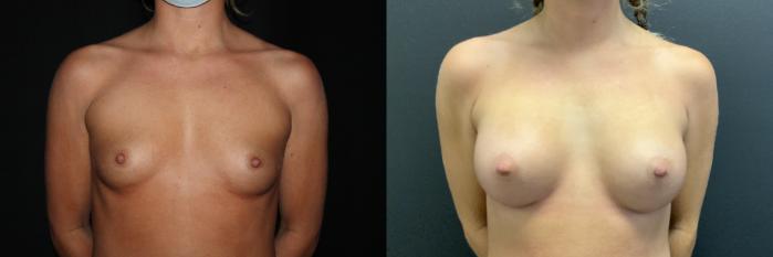 Before & After Breast Augmentation Case 84 Front View in Charleston, SC