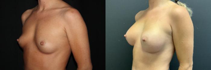 Before & After Breast Augmentation Case 84 Left Oblique View in Charleston, SC