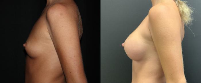 Before & After Breast Augmentation Case 84 Left Side View in Charleston, SC