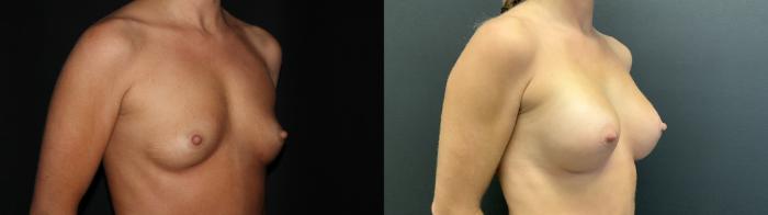 Before & After Breast Augmentation Case 84 Right Oblique View in Charleston, SC