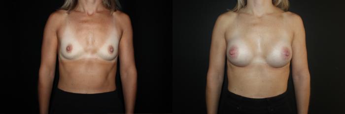 Before & After Breast Augmentation Case 85 Front View in Charleston, SC