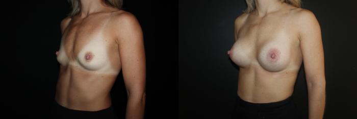 Before & After Breast Augmentation Case 85 Left Oblique View in Charleston, SC