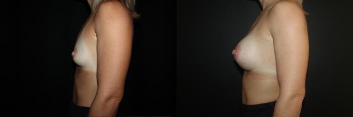 Before & After Breast Augmentation Case 85 Left Side View in Charleston, SC