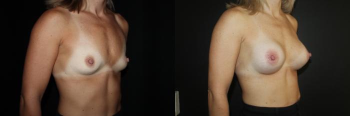 Before & After Breast Augmentation Case 85 Right Oblique View in Charleston, SC