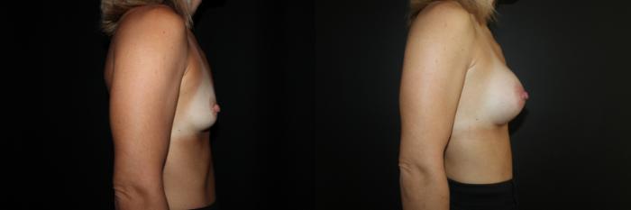 Before & After Breast Augmentation Case 85 Right Side View in Charleston, SC