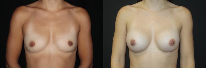 Before & After Breast Augmentation Case 86 Front View in Charleston, SC