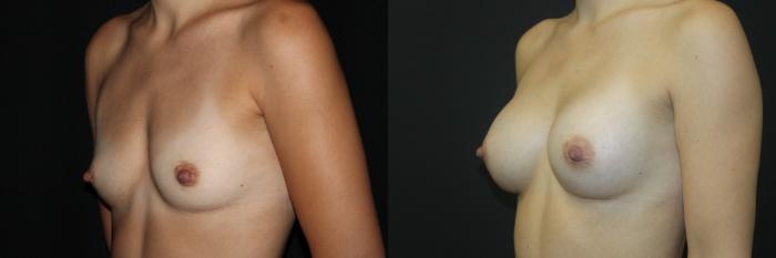 Before & After Breast Augmentation Case 86 Left Oblique View in Charleston, SC