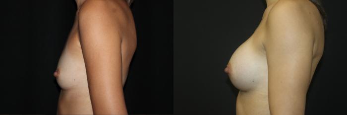 Before & After Breast Augmentation Case 86 Left Side View in Charleston, SC