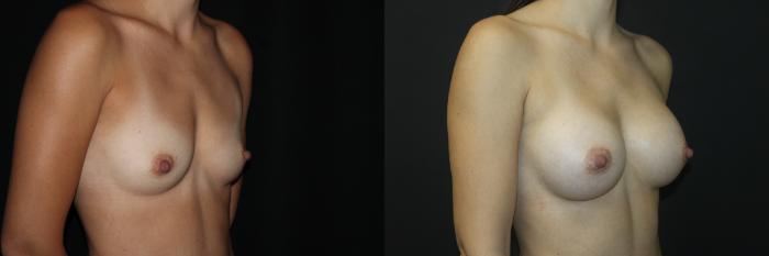 Before & After Breast Augmentation Case 86 Right Oblique View in Charleston, SC