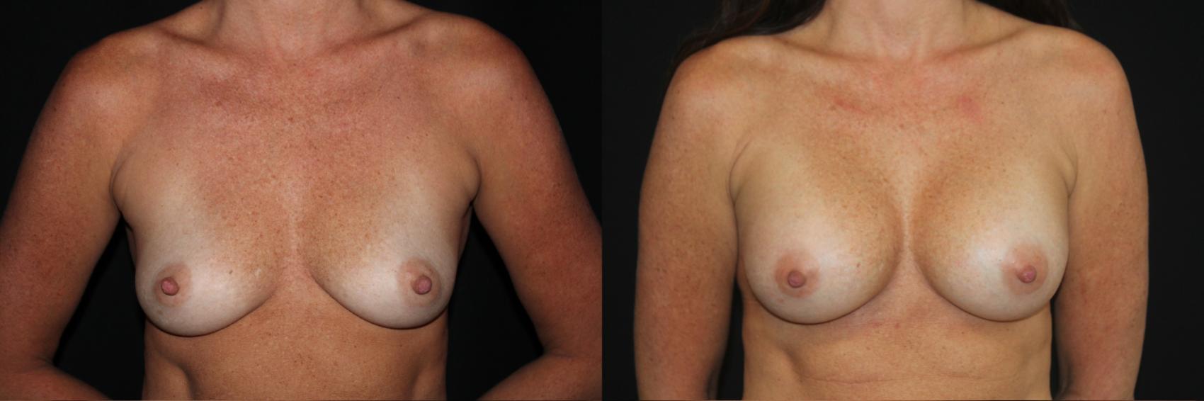 Before & After Breast Augmentation Case 87 Front View in Charleston, SC