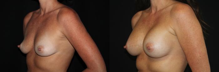 Before & After Breast Augmentation Case 87 Left Oblique View in Charleston, SC