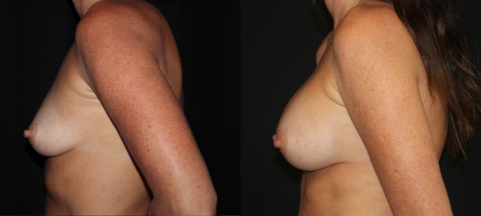 Before & After Breast Augmentation Case 87 Left Side View in Charleston, SC