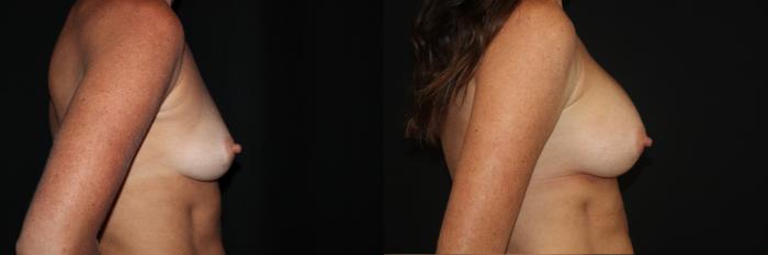 Before & After Breast Augmentation Case 87 Right Side View in Charleston, SC