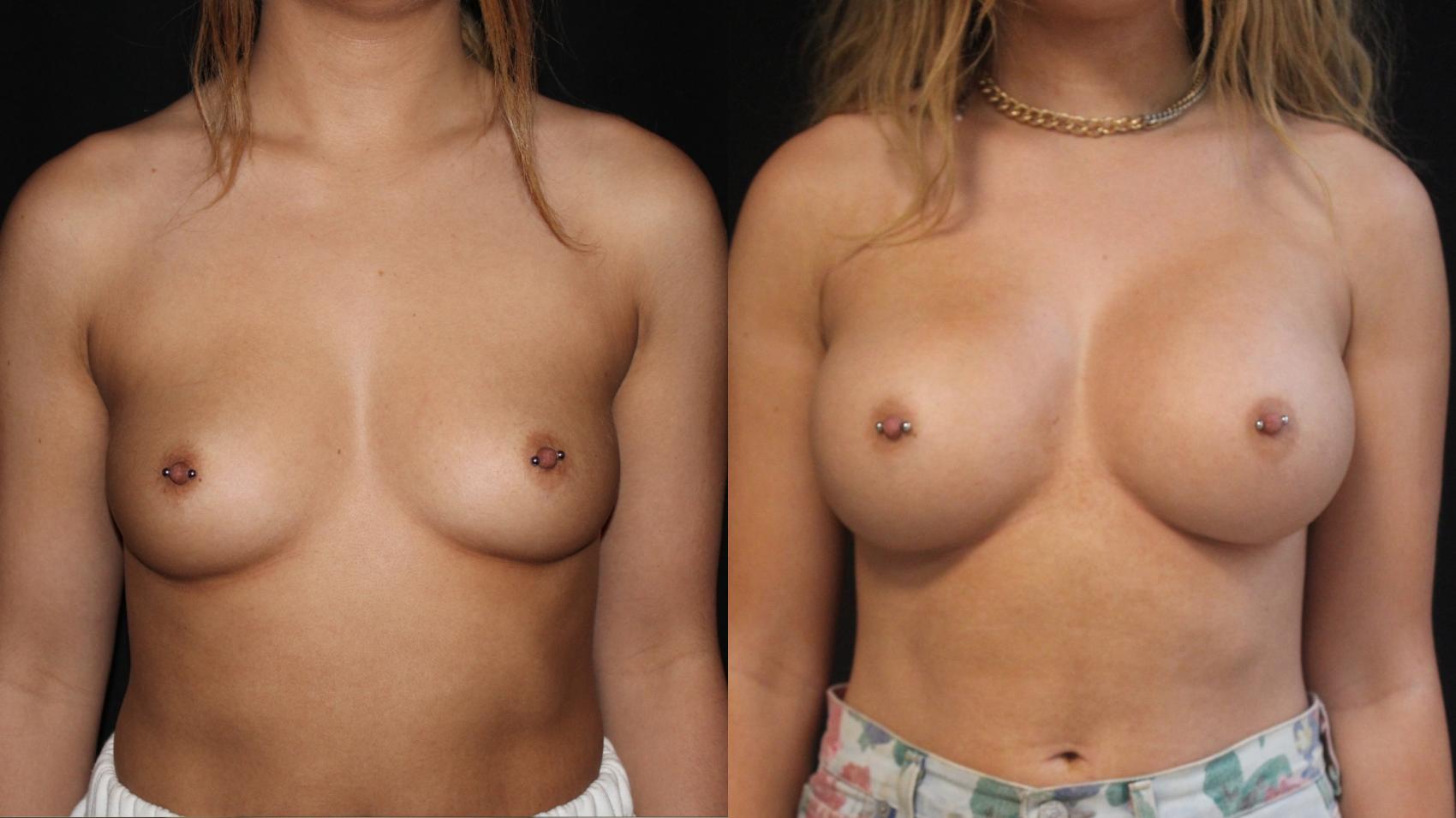 Before & After Breast Augmentation Case 88 Front View in Charleston, SC