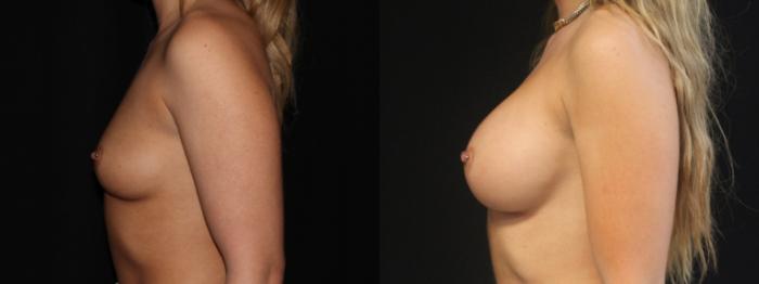 Before & After Breast Augmentation Case 88 Left Side View in Charleston, SC