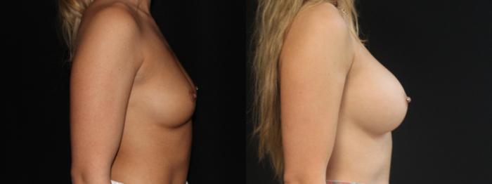 Before & After Breast Augmentation Case 88 Right Side View in Charleston, SC