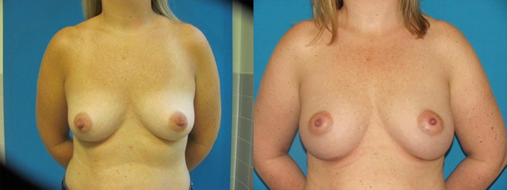 Before & After Breast Augmentation Case 9 Front View in Charleston, SC