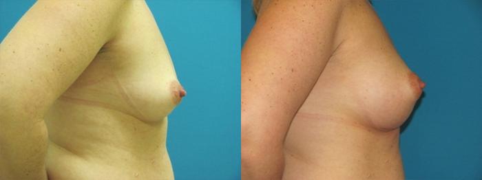 Before & After Breast Augmentation Case 9 Right Side View in Charleston, SC