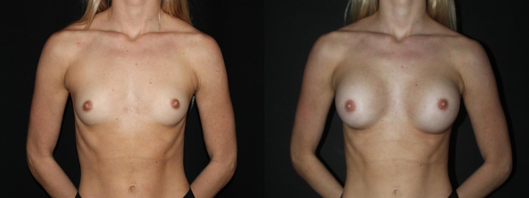 Before & After Breast Augmentation Case 90 Front View in Charleston, SC