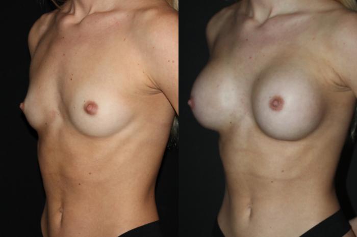 Before & After Breast Augmentation Case 90 Left Oblique View in Charleston, SC
