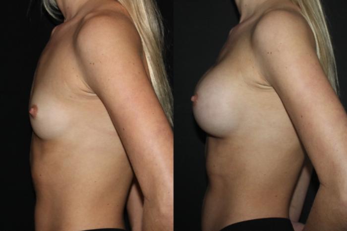Before & After Breast Augmentation Case 90 Left Side View in Charleston, SC