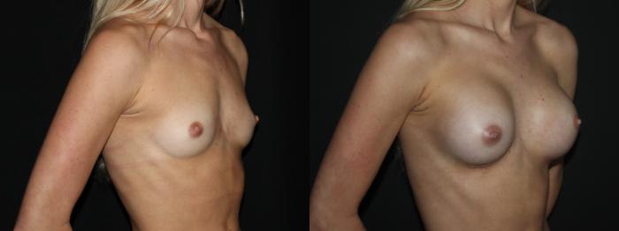 Before & After Breast Augmentation Case 90 Right Oblique View in Charleston, SC