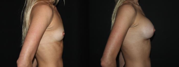 Before & After Breast Augmentation Case 90 Right Side View in Charleston, SC