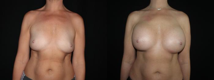 Before & After Breast Augmentation Case 94 Front View in Charleston, SC