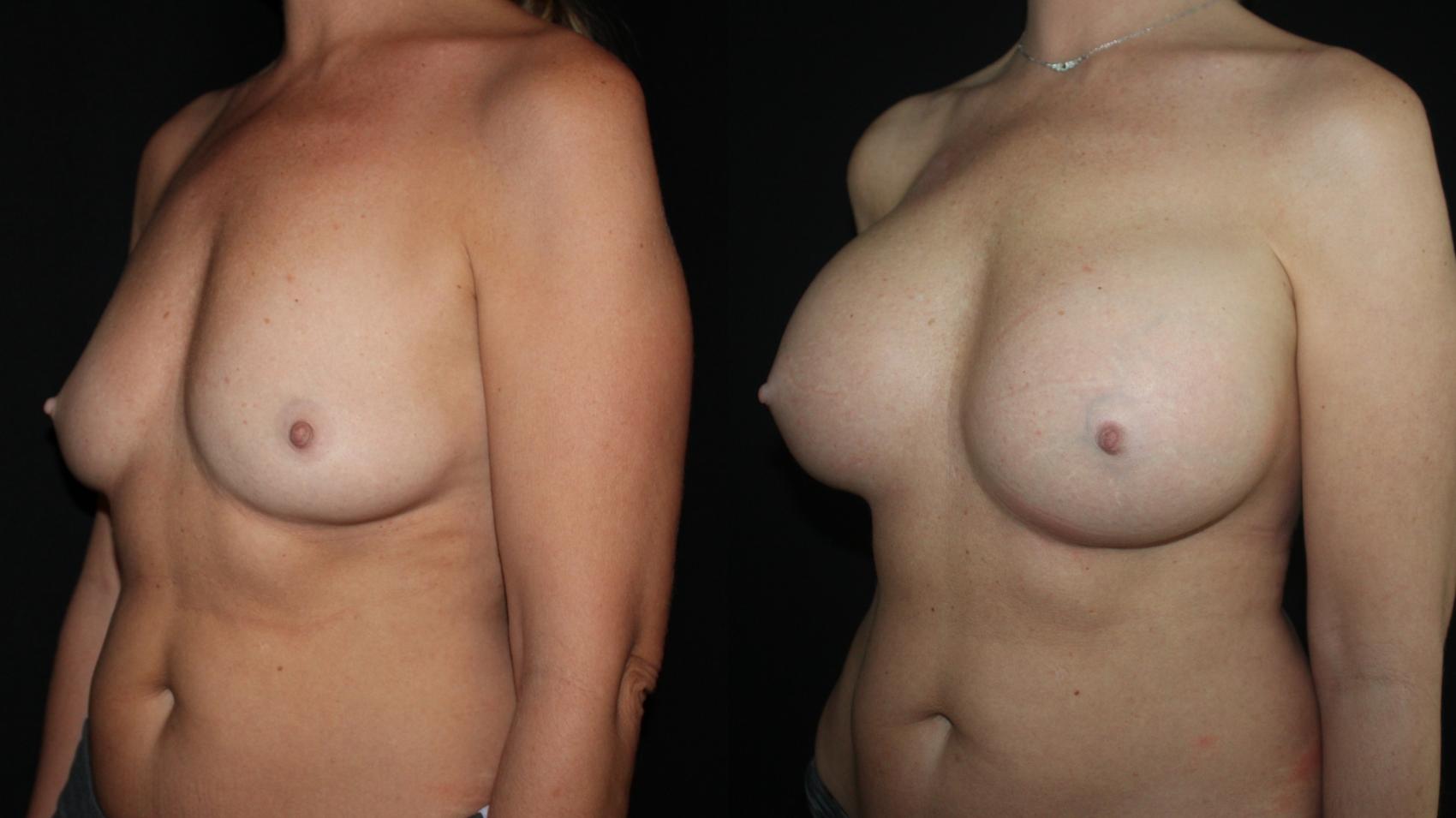 Before & After Breast Augmentation Case 94 Left Oblique View in Charleston, SC