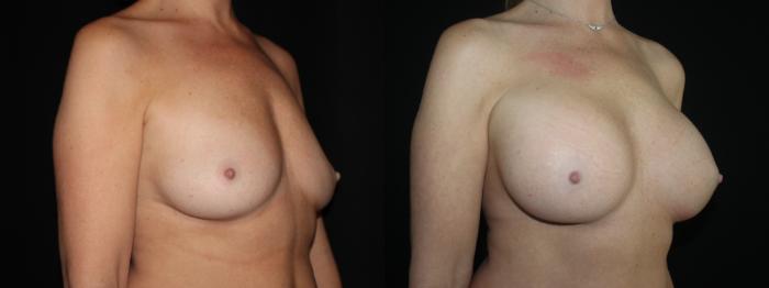 Before & After Breast Augmentation Case 94 Right Oblique View in Charleston, SC