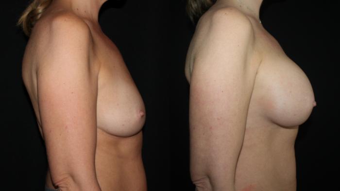 Before & After Breast Augmentation Case 94 Right Side View in Charleston, SC