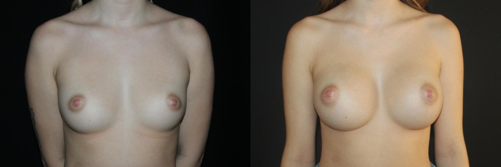 Before & After Breast Augmentation Case 95 Front View in Charleston, SC