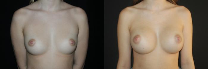 Before & After Breast Augmentation Case 95 Front View in Charleston, SC