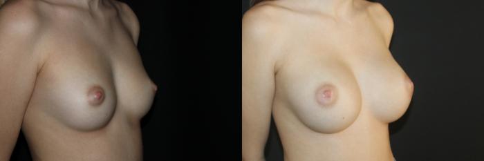 Before & After Breast Augmentation Case 95 Right Oblique View in Charleston, SC