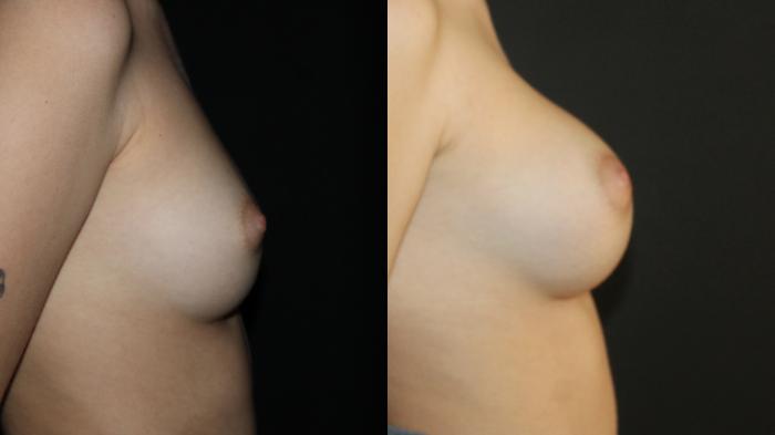 Before & After Breast Augmentation Case 95 Right Side View in Charleston, SC