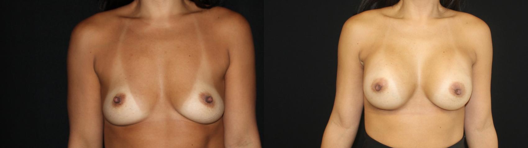 Before & After Breast Augmentation Case 96 Front View in Charleston, SC